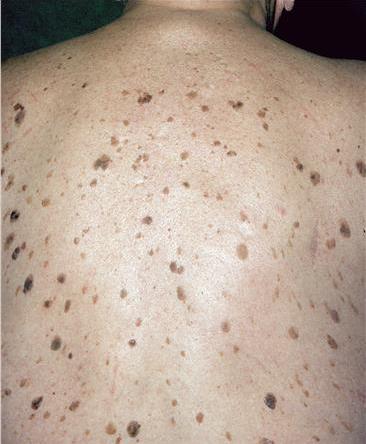 Seborrhoeic Keratosis3